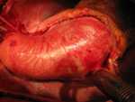 Aortic Aneurysm
