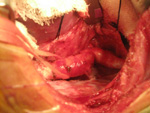 CABG LIMA RIMA Radial Grafts