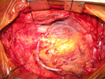 CABG LIMA RIMA Y Grafts