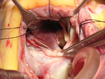 Carotid Endarterectomy