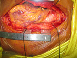 Carotid Endarterectomy Specimen