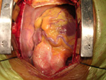 Coarctation of Aorta