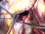Coarctation of Aorta Repair Done