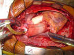 Aortic Root Replacement