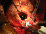 Aortic Valve Replacement