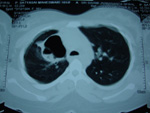 Beating Heart Surgery