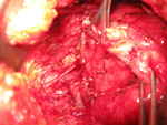 Beating Heart Surgery 1