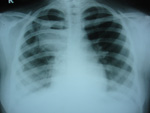 Beating Heart Surgery 2