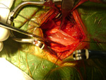 Bronchogenic Cyst Operated